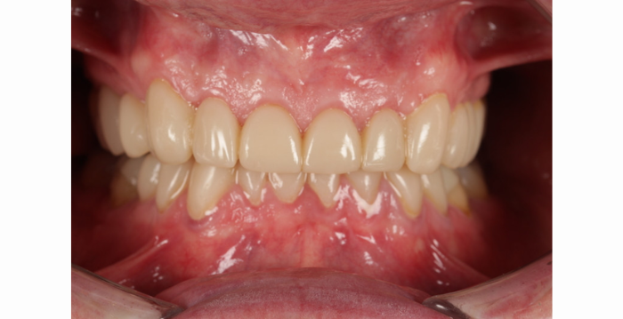 The final product showcases the power of 3D printing within the dental sector.